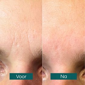 APRICOT Fronsrimpel Pads "face charmer" met ectoine