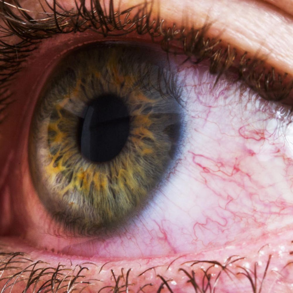 Gros plan sur un œil rouge. Veines rouges visibles sur le blanc de l'œil. Détails de l'iris et des cils.
