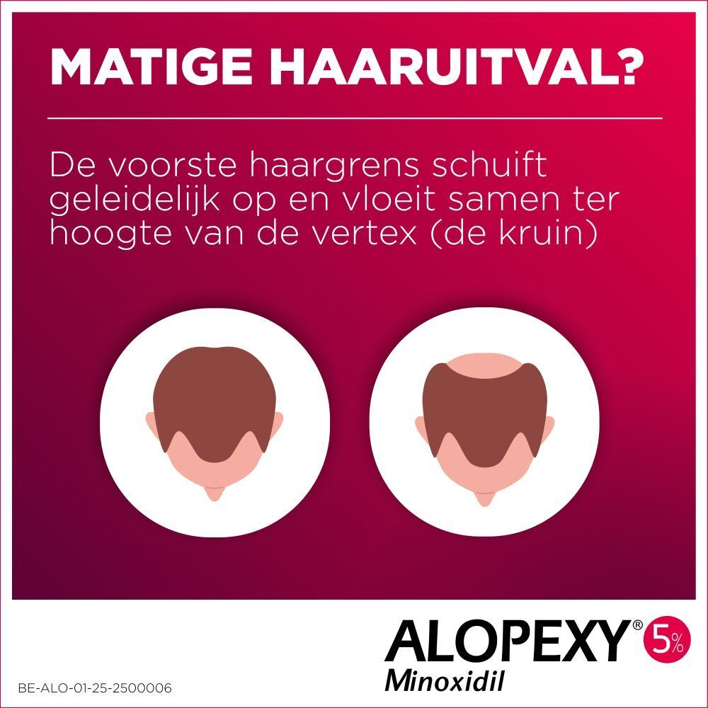 Grafiek: haaruitval bij mannen. Illustratie van de stadia van haaruitval. Tekst in het Nederlands.