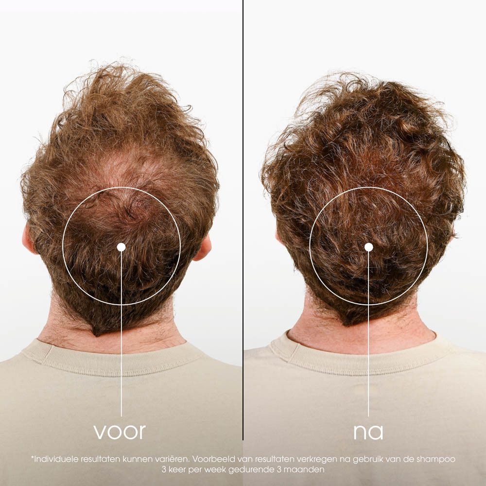 Voor-en-na-beeld van mannen met haaruitval. Tekst: voor, na.
