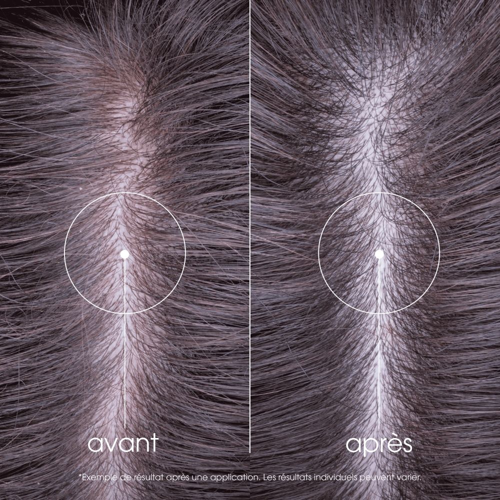Comparaison avant/après du cuir chevelu : réduction des pellicules.