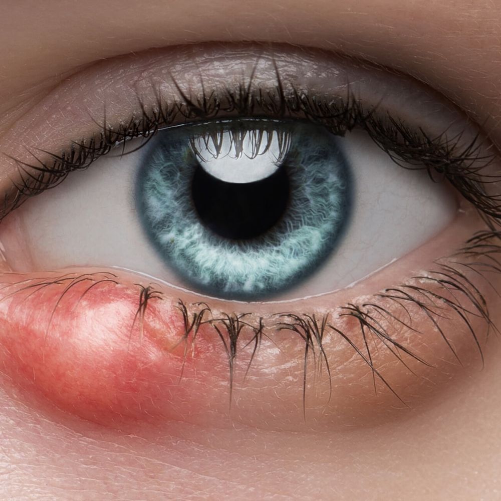 Gros plan sur un œil avec un orgelet sur la paupière inférieure. L'œil est bleu.