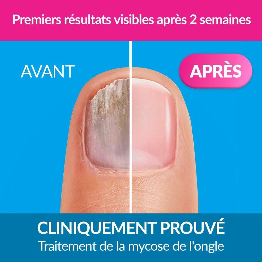 Excilor® XL Traitement de la Mycose des Ongles