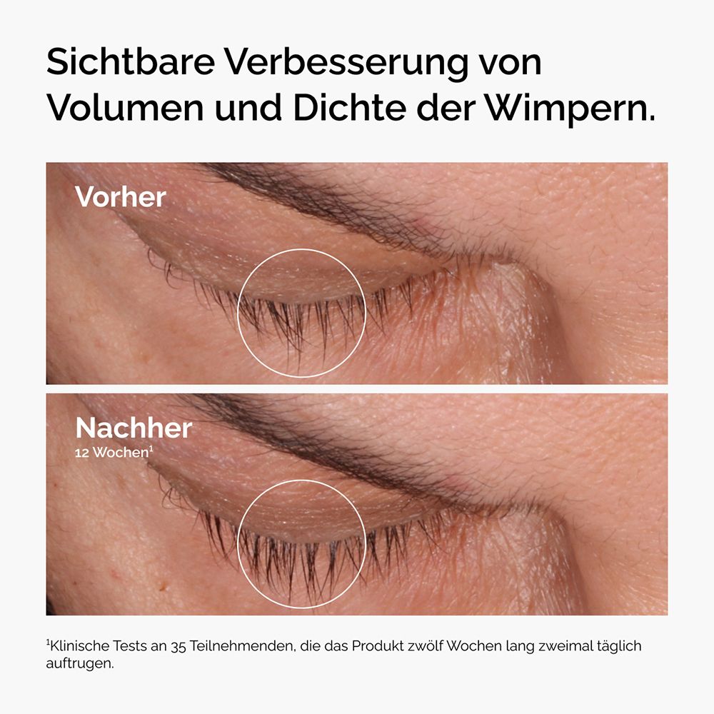 Comparaison des cils avant et après 12 semaines. Amélioration de la densité.