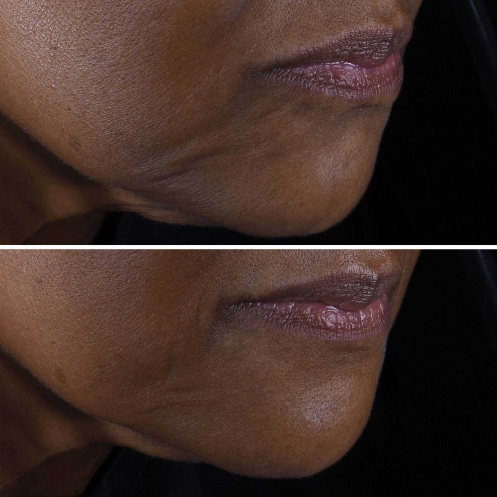 Image avant-après du visage d'une femme, focus sur la zone du menton.
