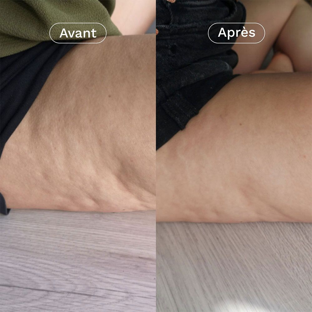Texte sur l'image : Réduit la cellulite et la peau d'orange en 30 jours. Favorise l'amincissement.