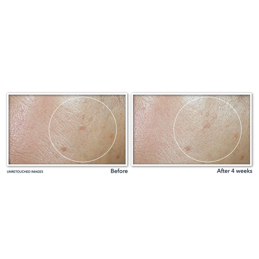 Voor-en-na vergelijking. Huidzones. Product: Roc Multi Correxion.
