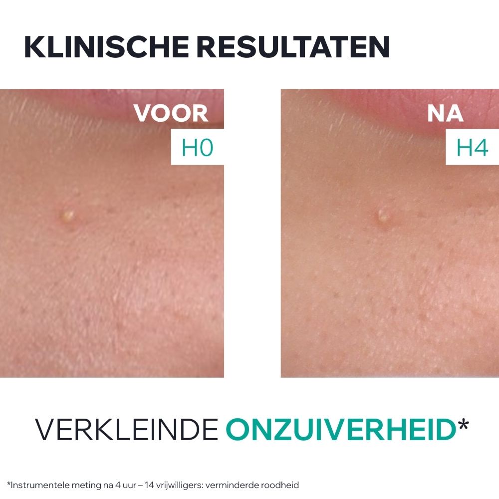 Uriage Hyseac Gel SOS: Laboratoriumapparatuur met vloeistoffen. "Formule dermatologique avancée". Bevat AHA en BHA.