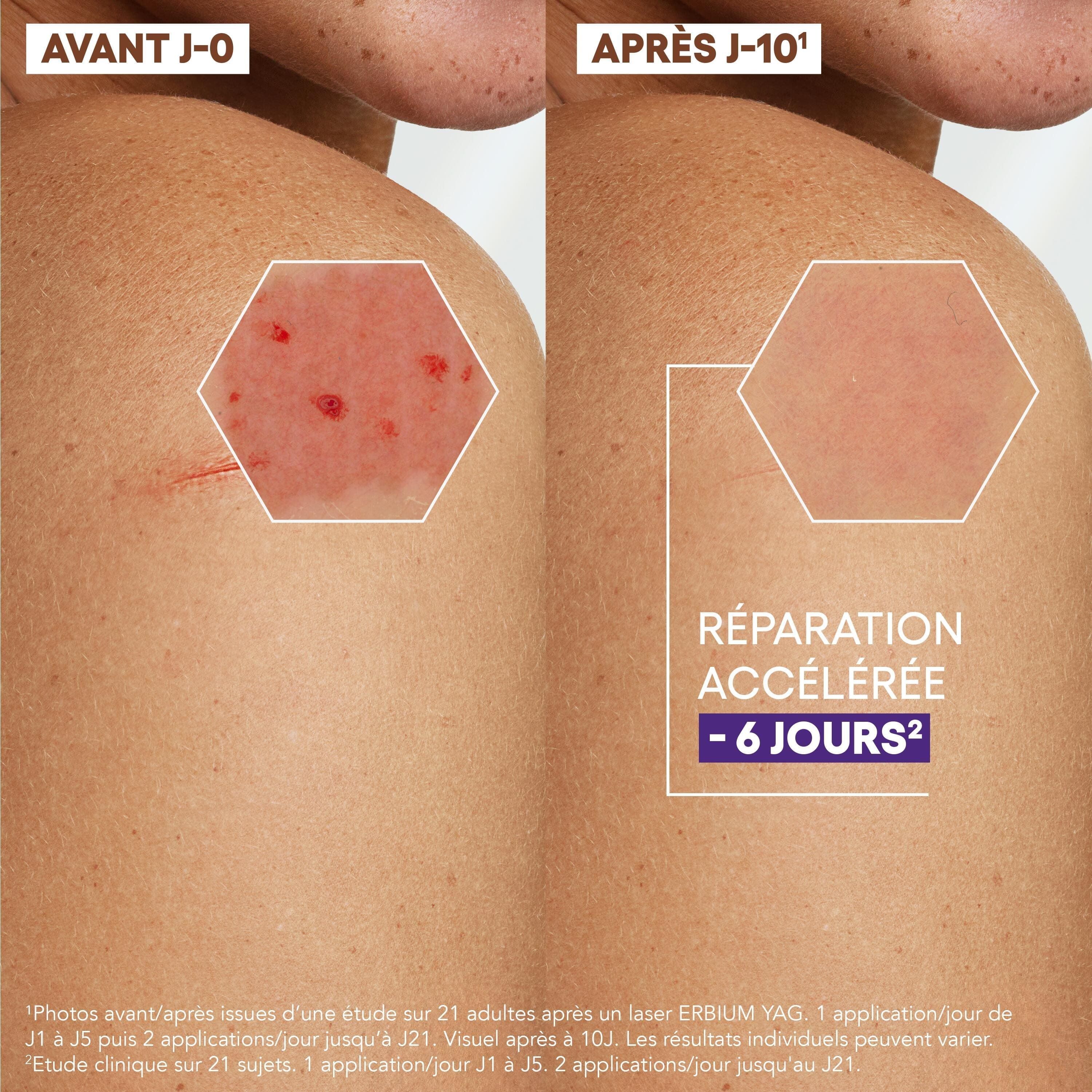 Images avant-après. Peau avec lésions. Texte : Réparation accélérée - 6 jours.