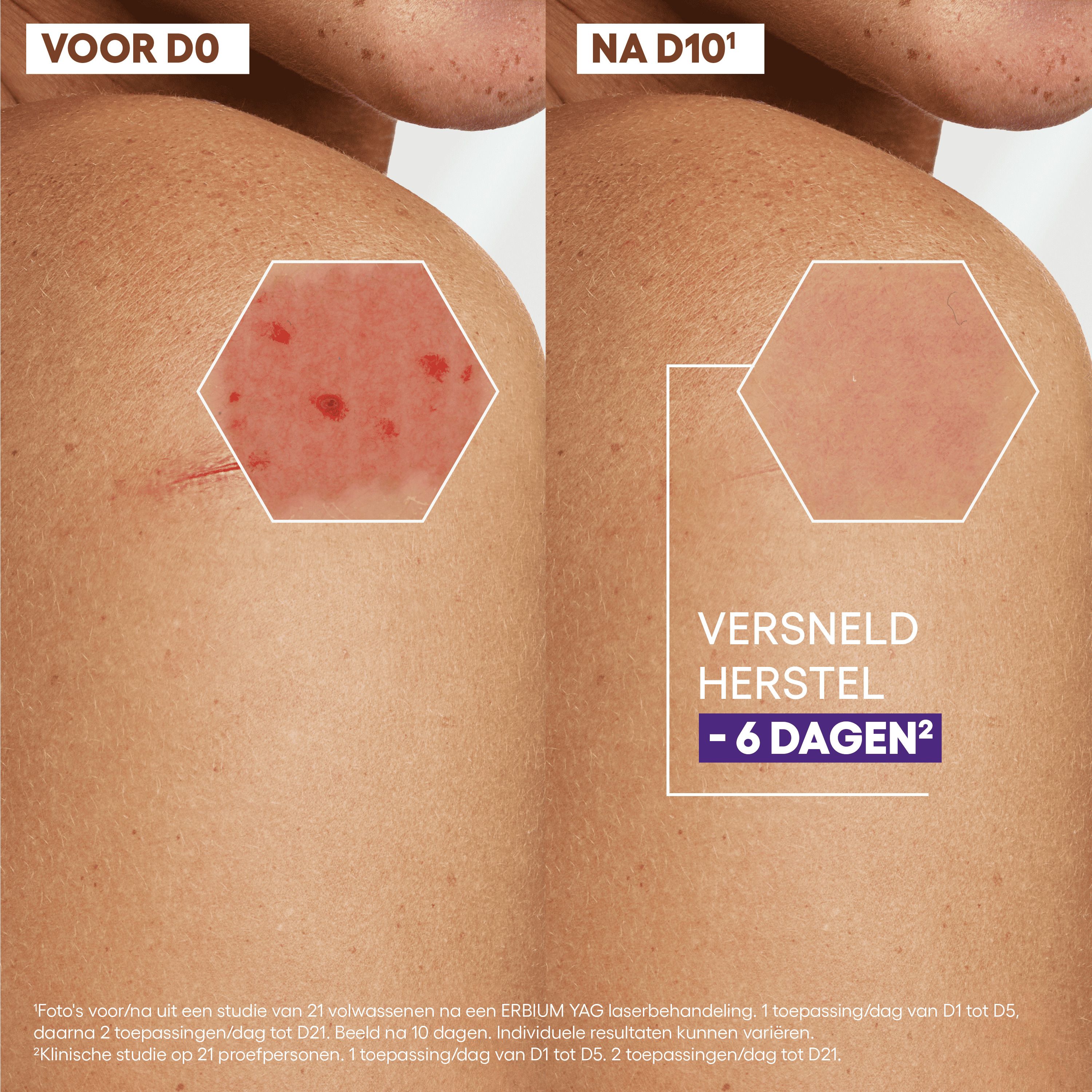 Voor- en na-afbeeldingen. Huid met letsel. Tekst: Versneld herstel - 6 dagen.
