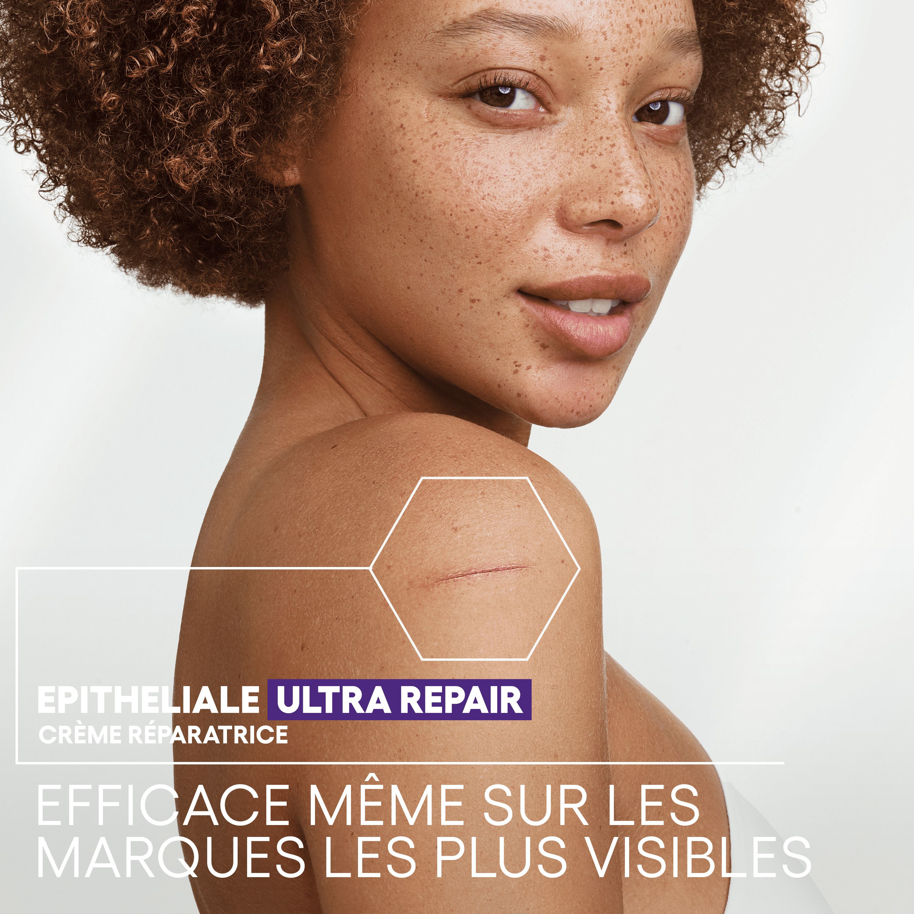 Femme avec cicatrice sur l'épaule. Texte: EPITHELIALE ULTRA REPAIR, EFFICACE MÊME SUR LES MARQUES LES PLUS VISIBLES.