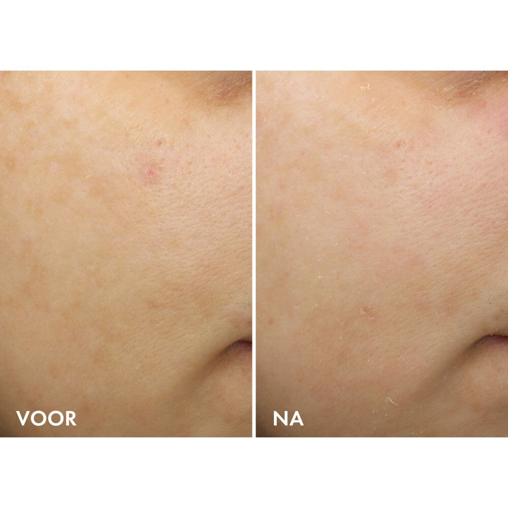 Huidvergelijking: voor en na. Close-up van huid.