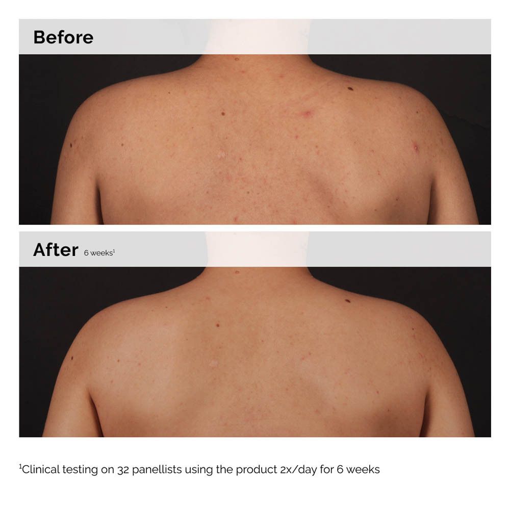 Deux images côte à côte : dos avant et après utilisation. Texte : Clinical testing on 32 panellists using the product 2x/day for 6 weeks.