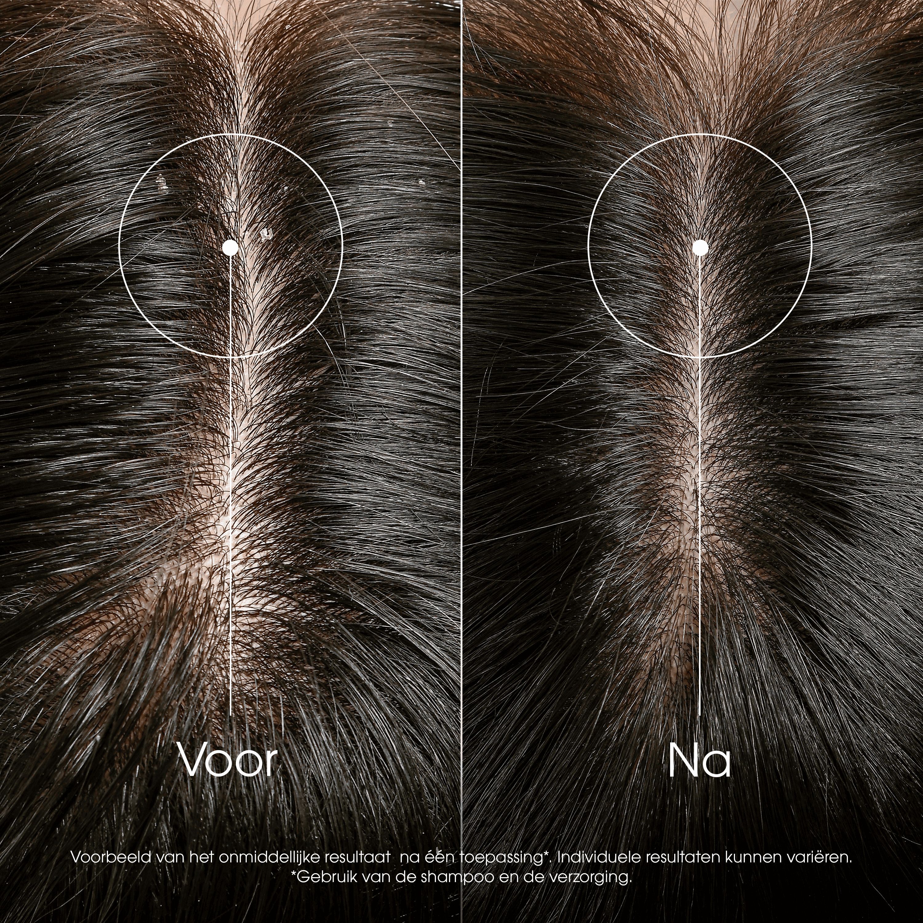 Groene fles met witte applicator. Klorane Antipelliculaire. Anti-roos behandeling.