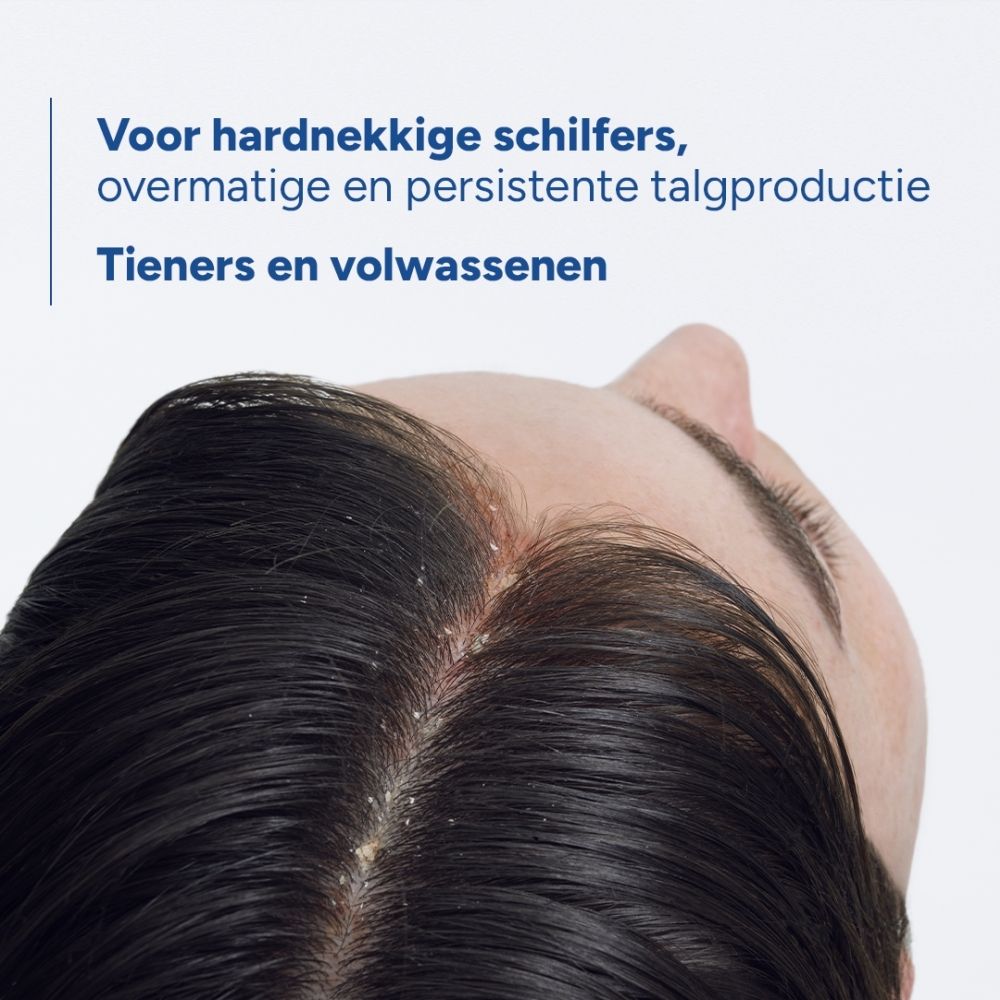 Close-up van de hoofdhuid van een persoon met roos. Tekst beschrijft het probleem.