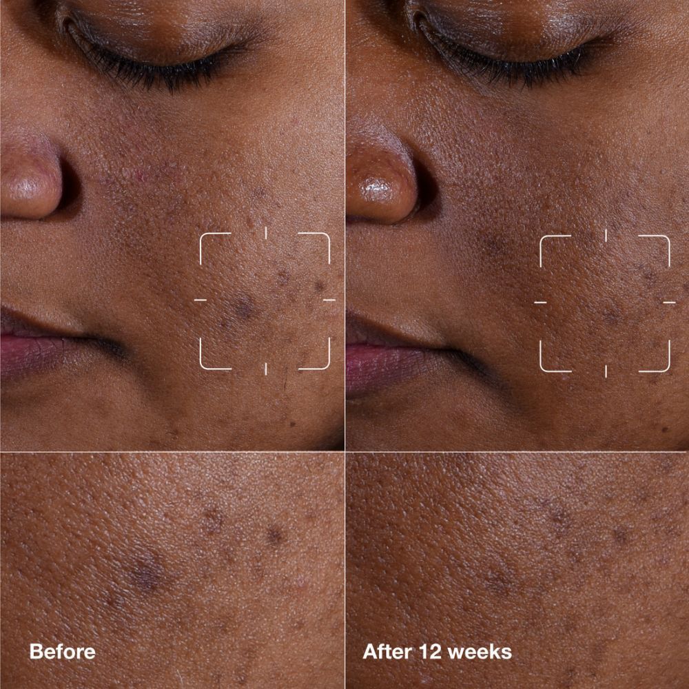 Zones de peau avant et après 12 semaines. Taches sombres réduites. Nom de la marque ou du produit non visible.