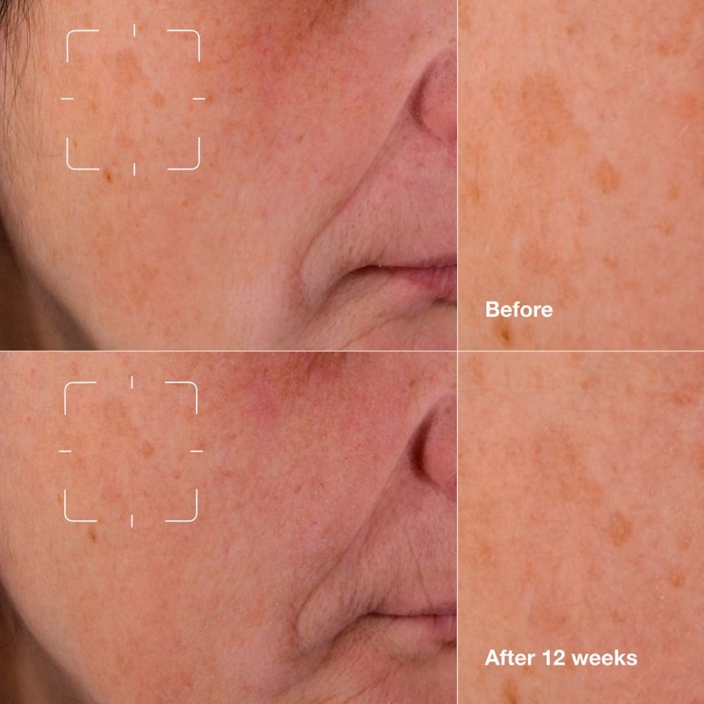 Zones de peau avant et après 12 semaines. Taches claires réduites. Nom de la marque ou du produit non visible.