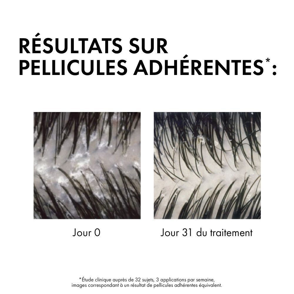 Images du cuir chevelu avant et après traitement. Texte: Résultats sur pellicules adhérentes.