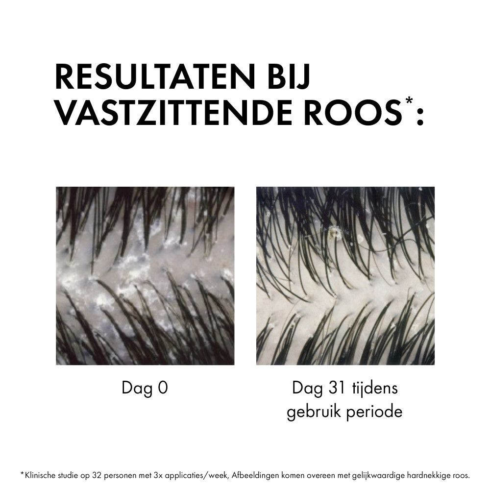 Hoofdhuid afbeeldingen voor en na behandeling. Tekst: Resultaten bij vastzittende roos.