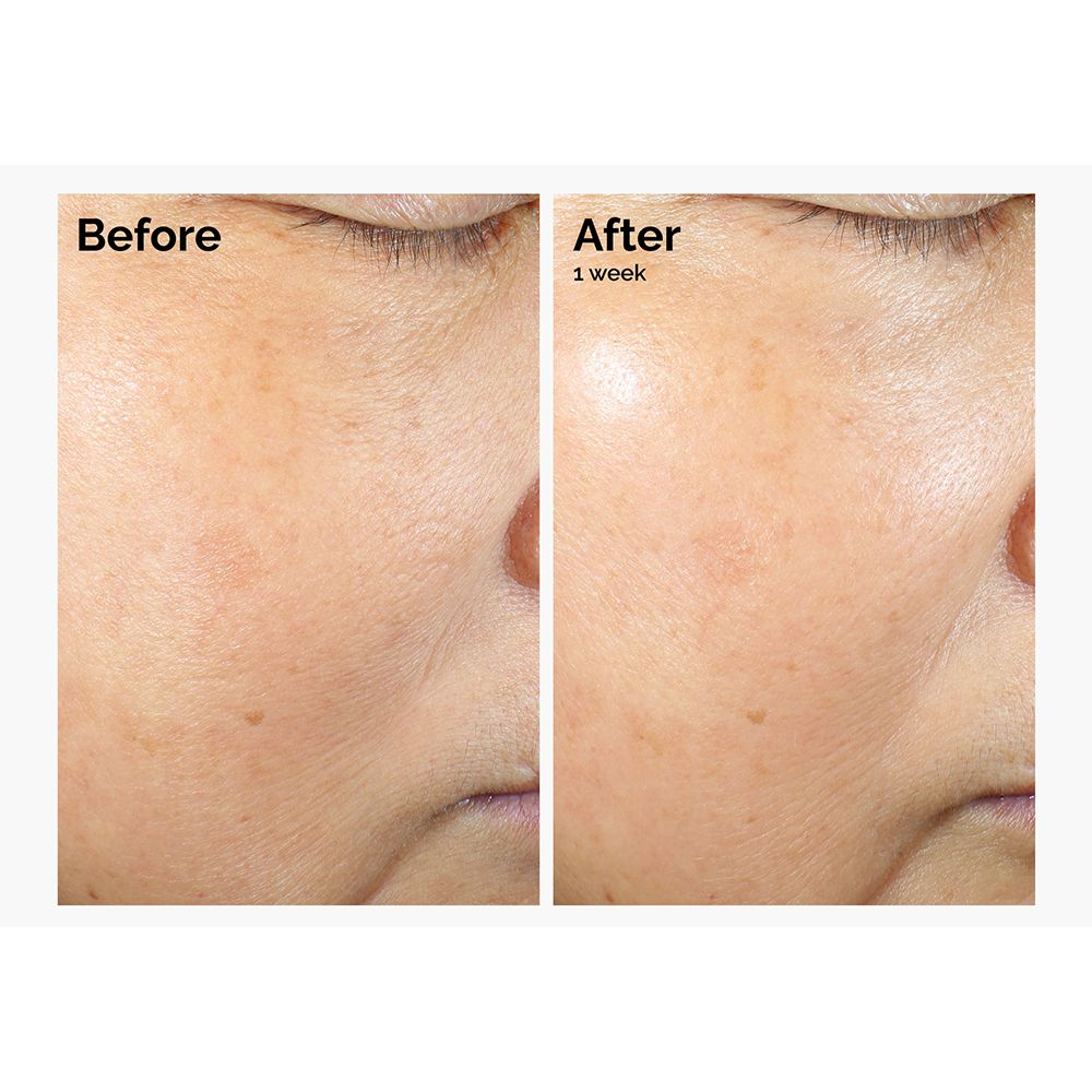 Comparaison avant-après. Peau du visage. Texte: Before, After 1 week.