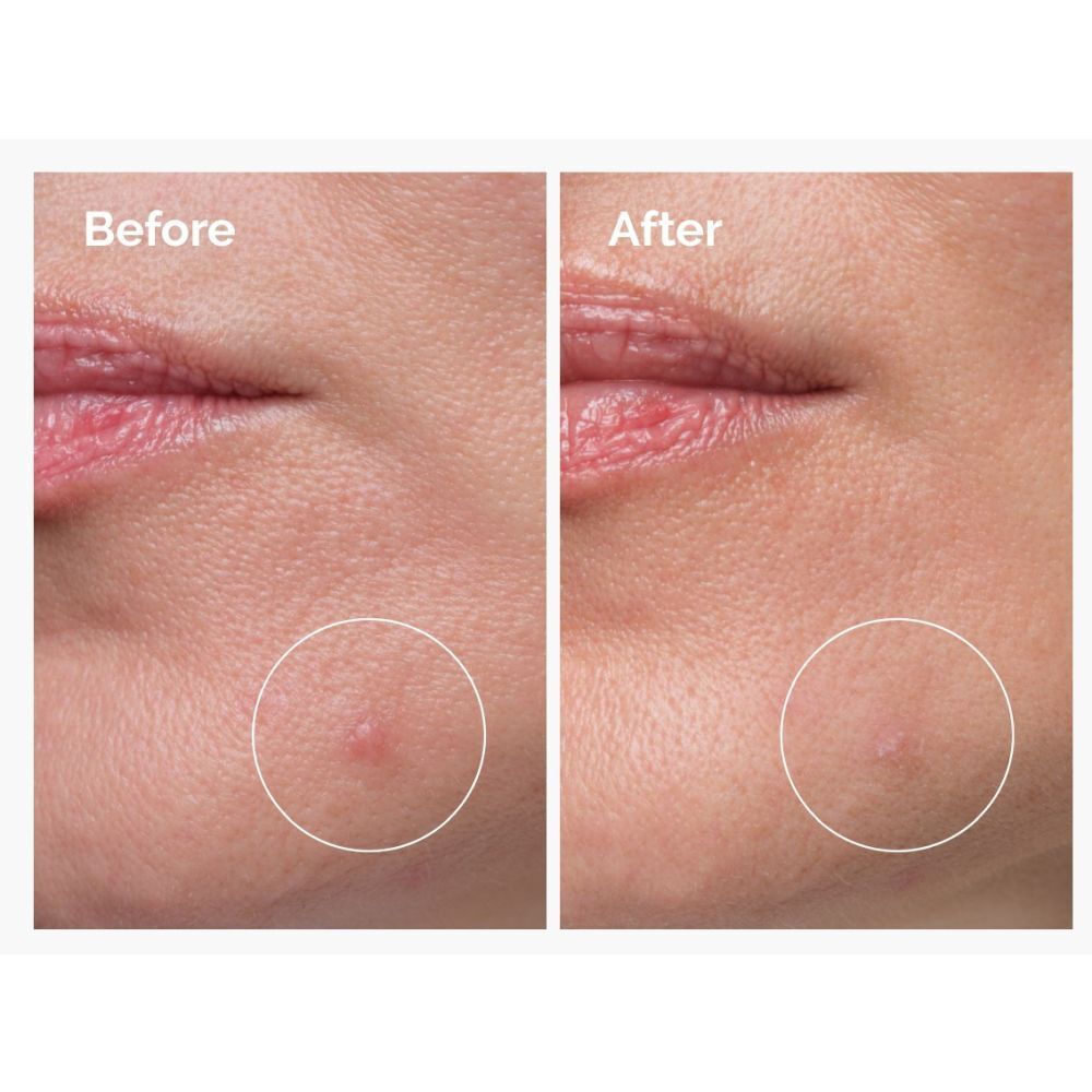 Voor-en-na-afbeelding. Huid met puistje voor en na The Ordinary Concentré Crème-en-Poudre de Soufre 10 %.