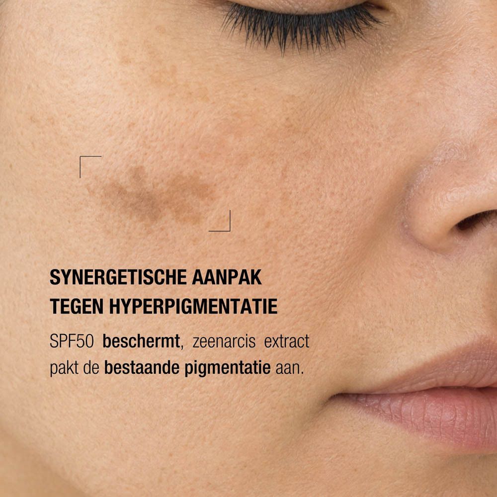 Close-up van een gezicht met pigmentvlekken, 'Synergetische aanpak tegen hyperpigmentatie'.
