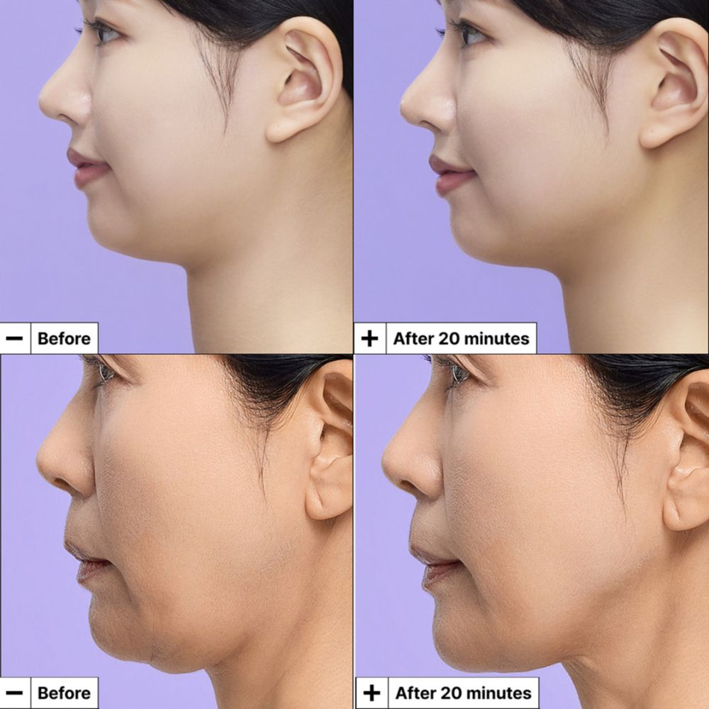 Voor-en-na vergelijking van de kaaklijn van een vrouw na gebruik van het Dr. Jart+ Cryo-V Kaaklijn Lifting Mask.