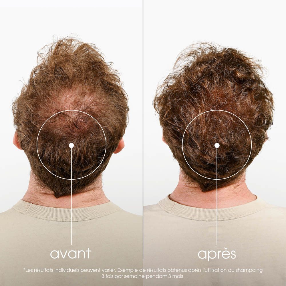 Comparaison avant-après de la densité capillaire à l'arrière de la tête d'un homme.