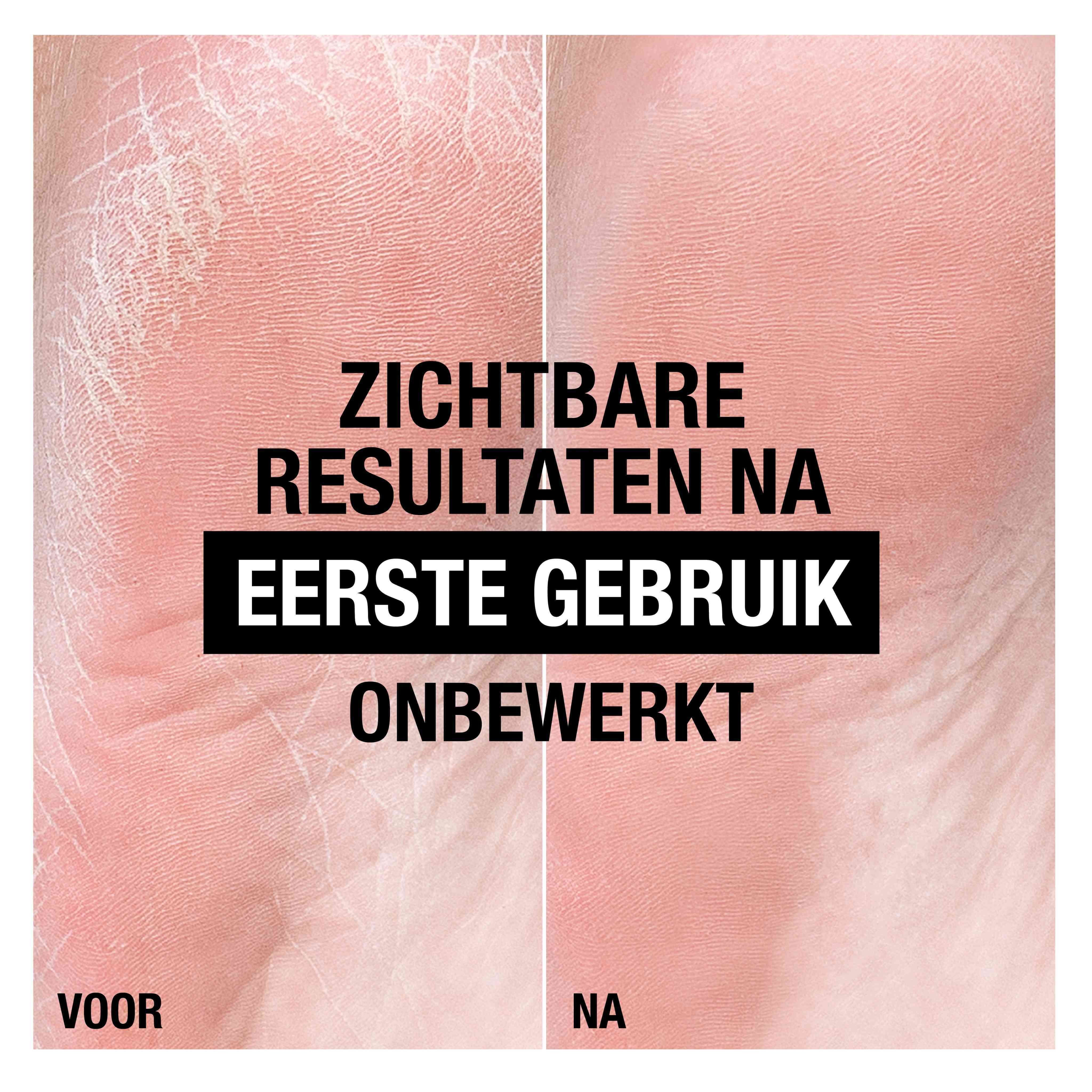 Vergelijking van droge voeten voor en na gebruik van Neutrogena®.