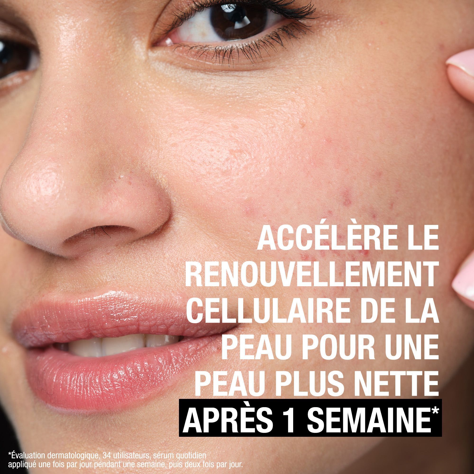 Gros plan d'un visage avec imperfections. Texte: Accélère le renouvellement cellulaire de la peau pour une peau plus nette après 1 semaine.