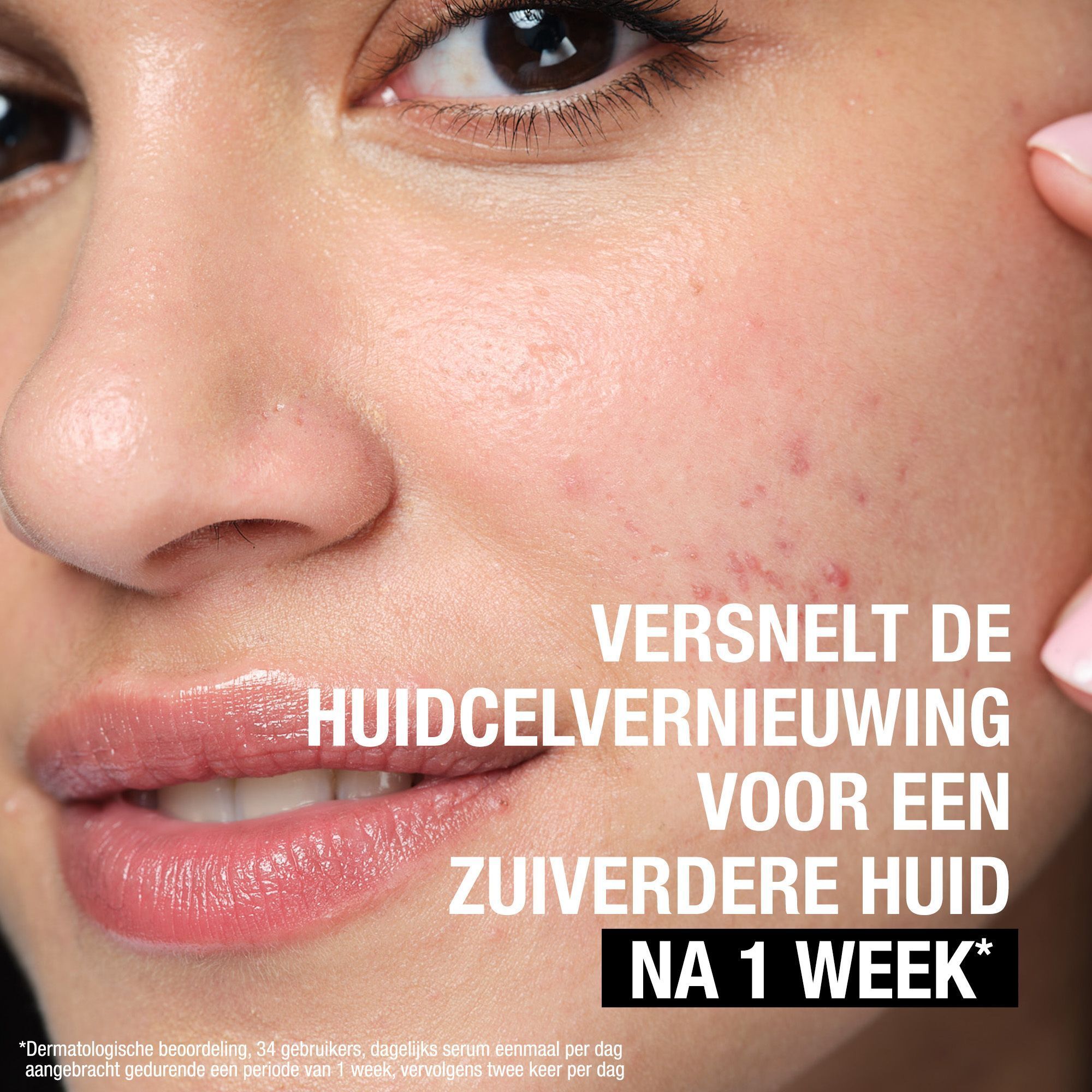 Close-up van een gezicht met onzuiverheden. Tekst: Versnelt de huidcelvernieuwing voor een zuiverdere huid na 1 week.