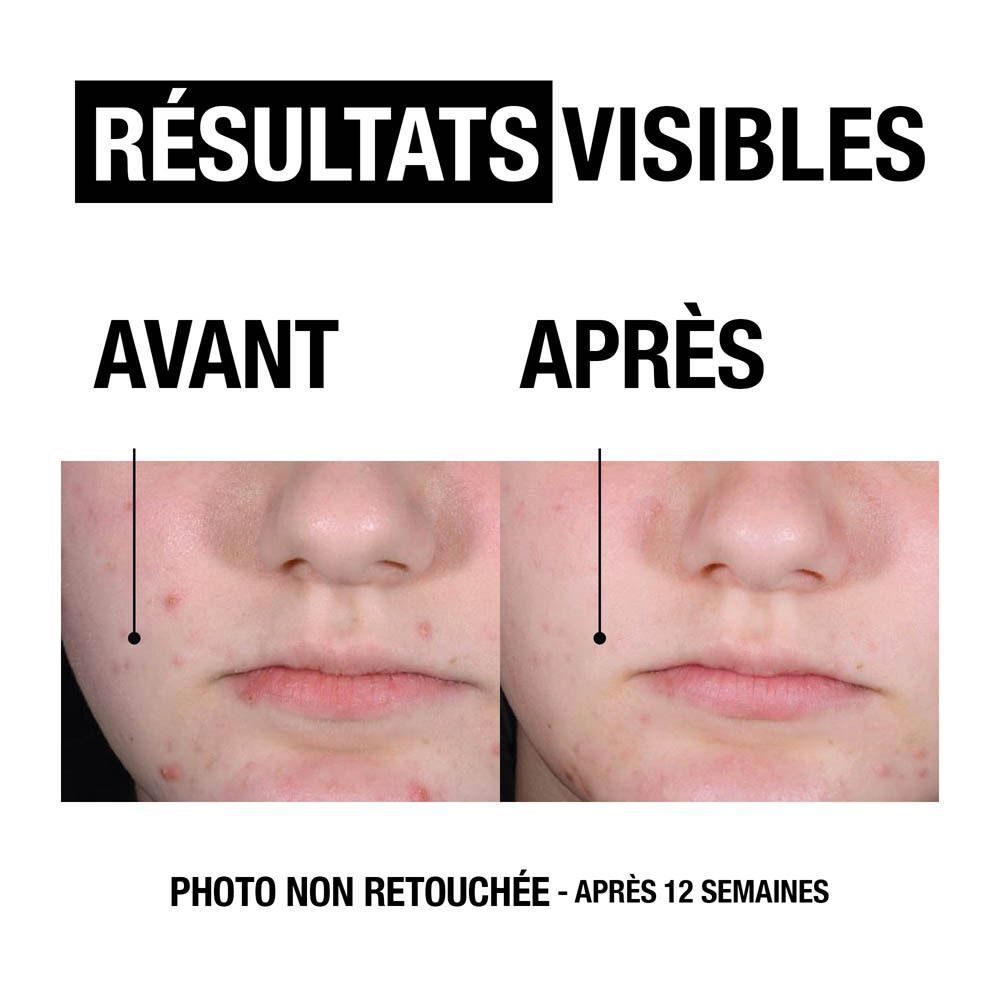 Comparaison avant-après des imperfections cutanées. Les moitiés de visage montrent la peau avant et après 12 semaines de traitement. Texte : PHOTO NON RETOUCHÉE.