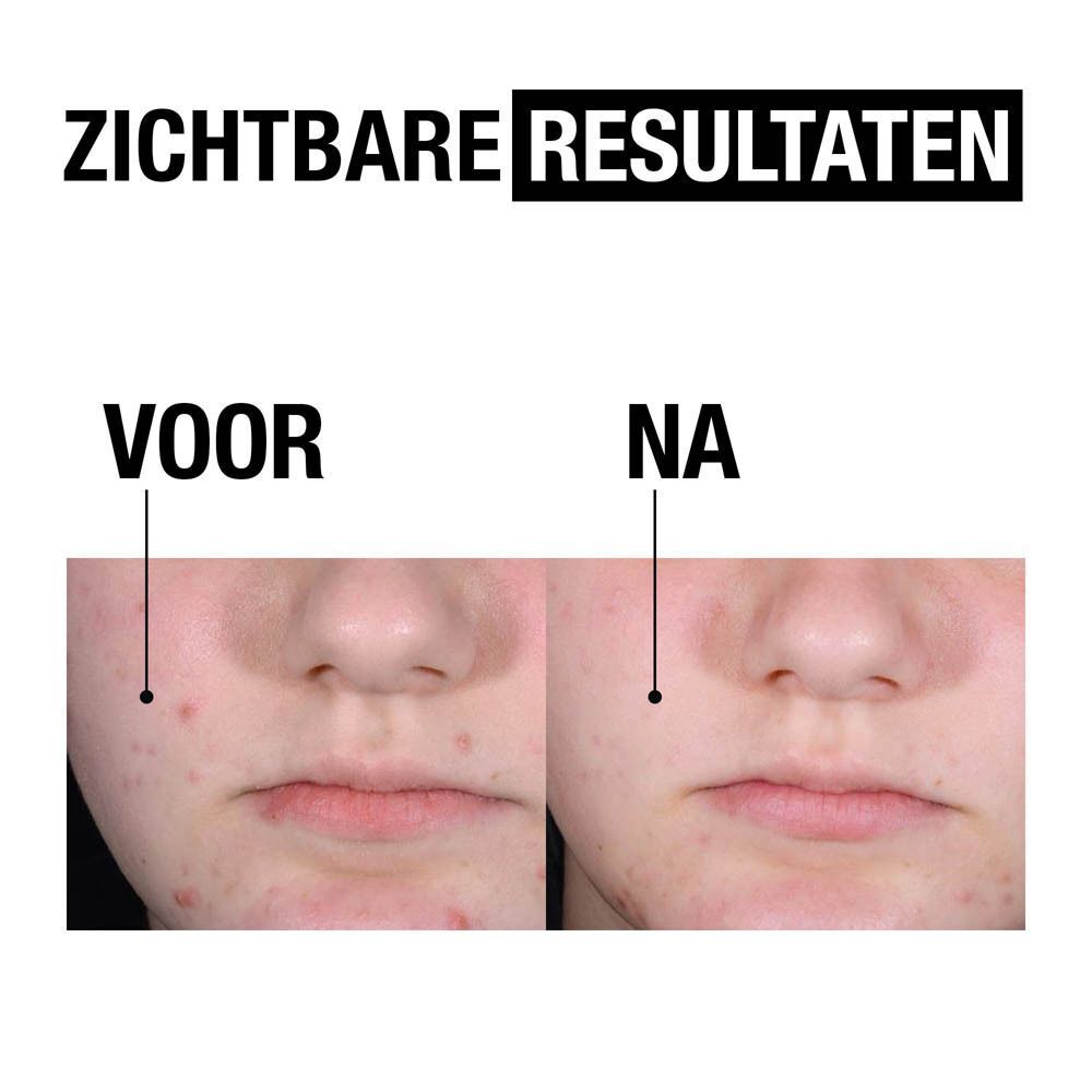 Voor-en-na vergelijking van huidonzuiverheden. Gezichtshelften tonen huid voor en na de behandeling.