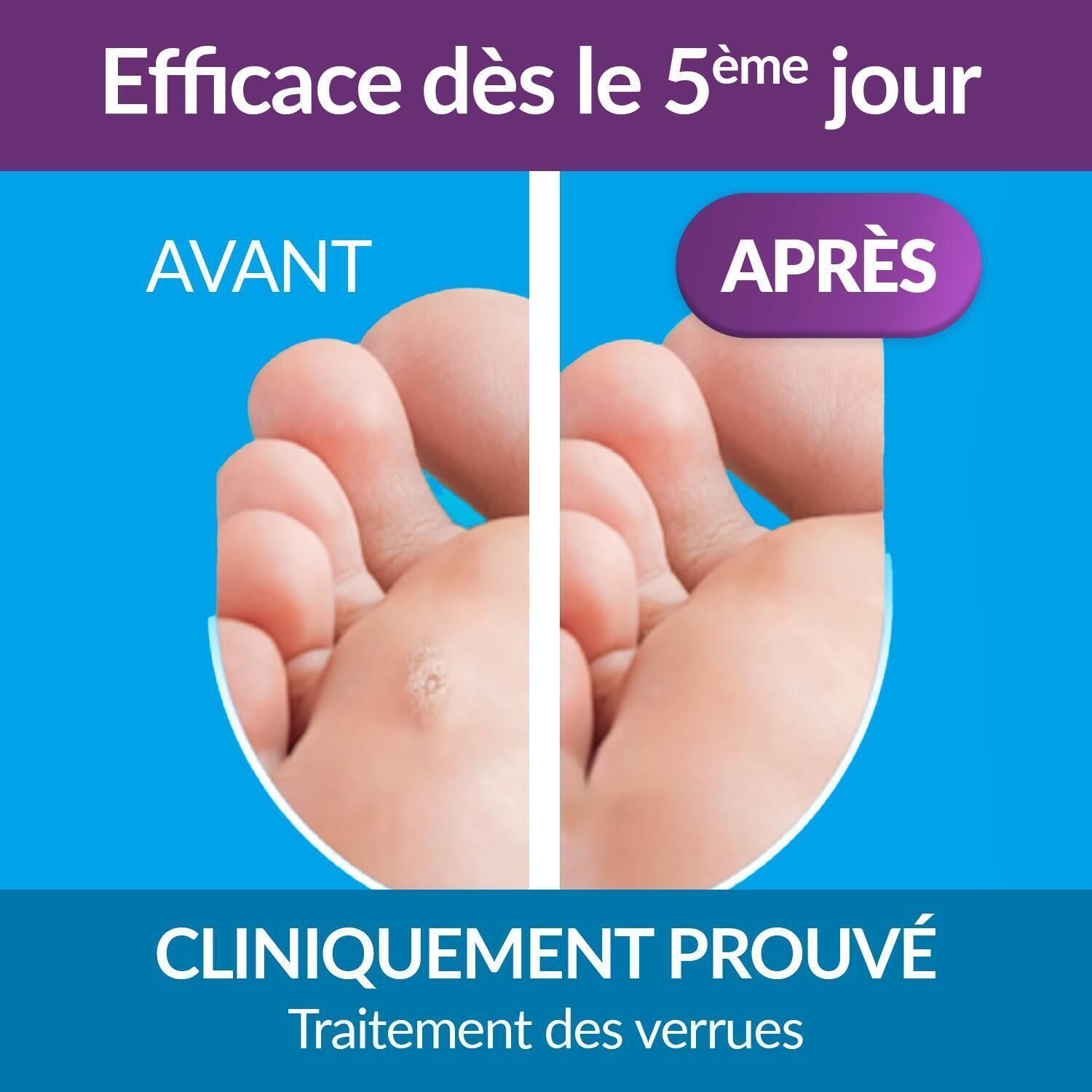 Représentation avant-après d'un pied avec verrue. Texte : Efficace dès le 5ème jour. Cliniquement prouvé. Traitement des verrues.