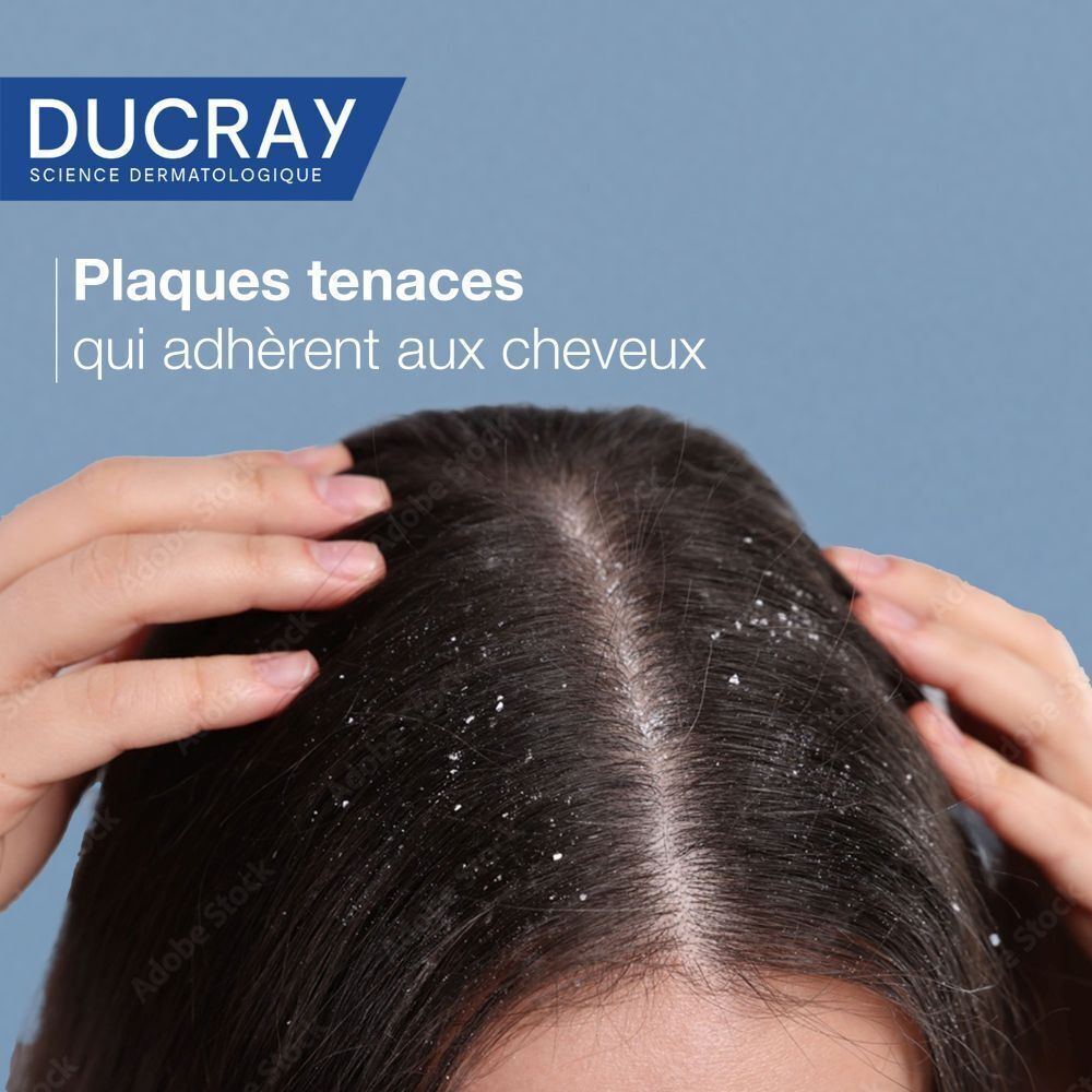 Gros plan d'une tête avec des pellicules sur les cheveux. Texte : Plaques tenaces qui adhèrent aux cheveux.