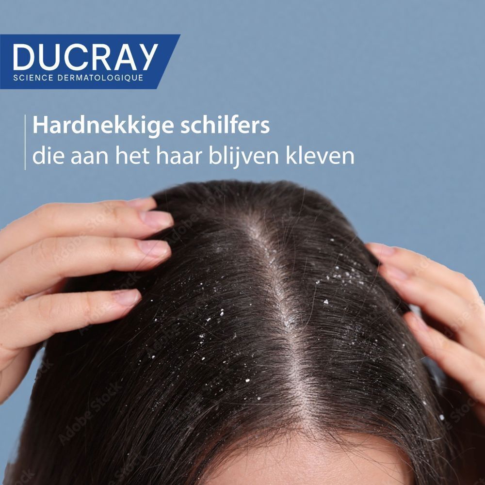 Close-up van een hoofd met roos op het haar. Tekst: Hardnekkige schilfers die aan het haar blijven kleven.