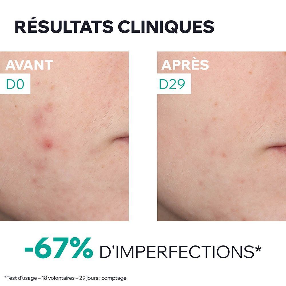 Comparaison avant-après de la peau montrant une réduction des imperfections.