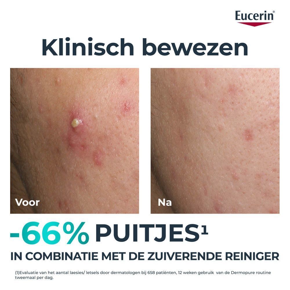 Voor/na vergelijking van acne-gevoelige huid behandeld met Eucerin.