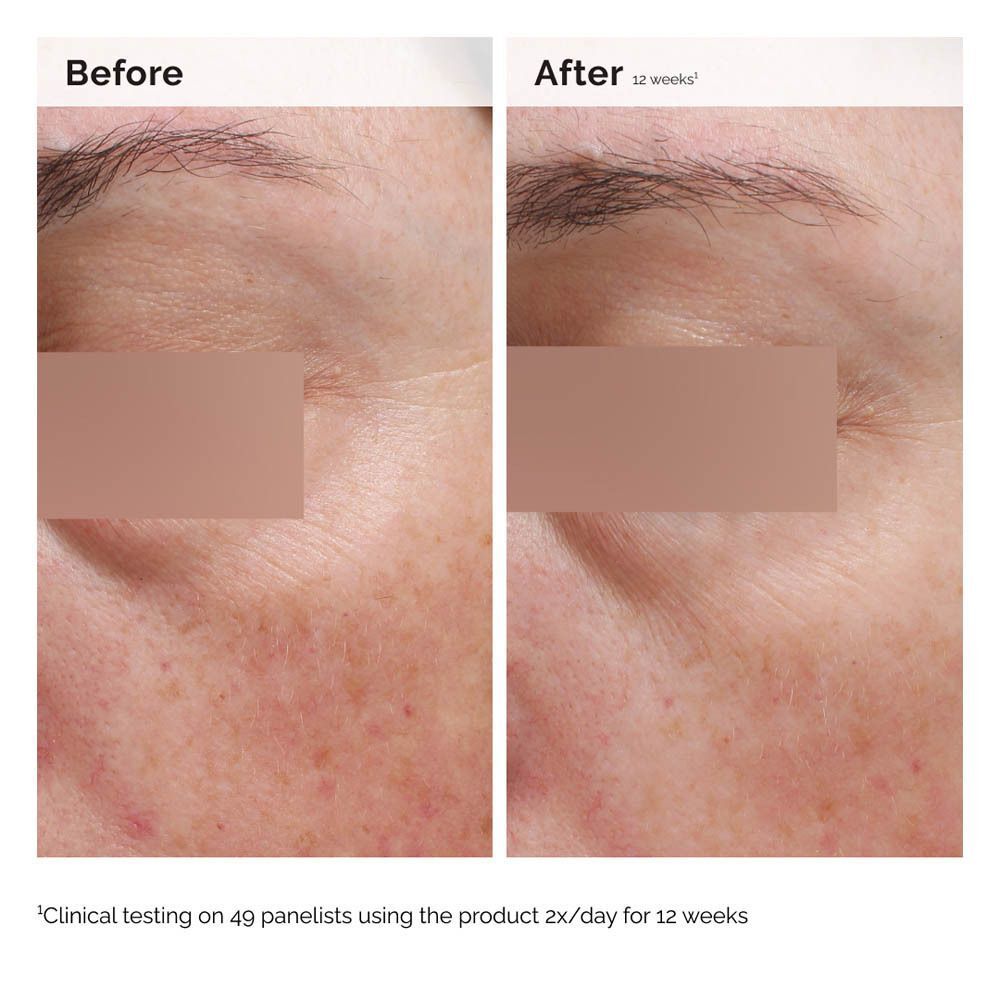 Comparaison avant-après de la peau. Texte : Clinical testing on 49 panelists using the product 2x/day for 12 weeks.