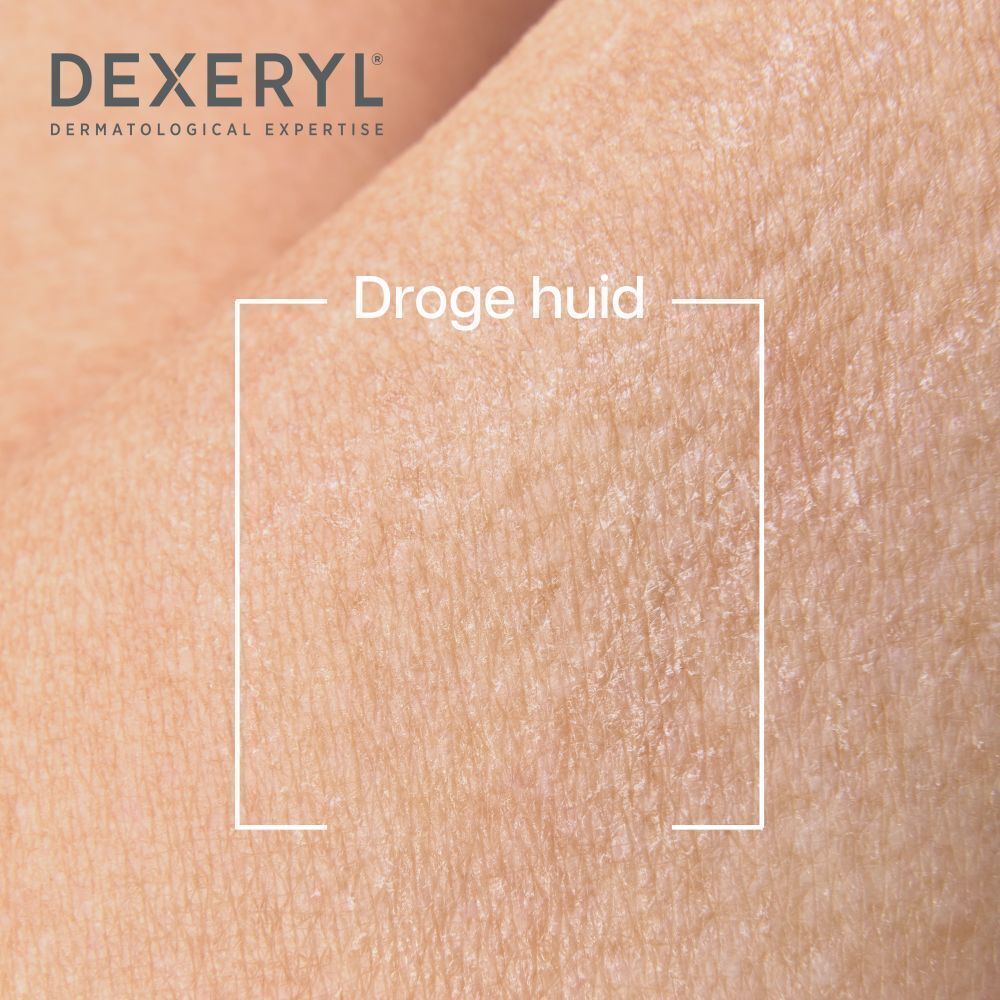 Close-up van droge huid. Vierkante markering. Tekst: Droge huid.