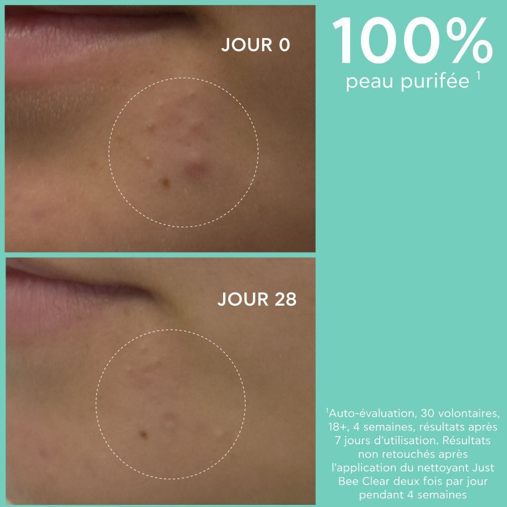 Images avant-après d'imperfections cutanées. Texte: 100% peau purifiée après 4 semaines.