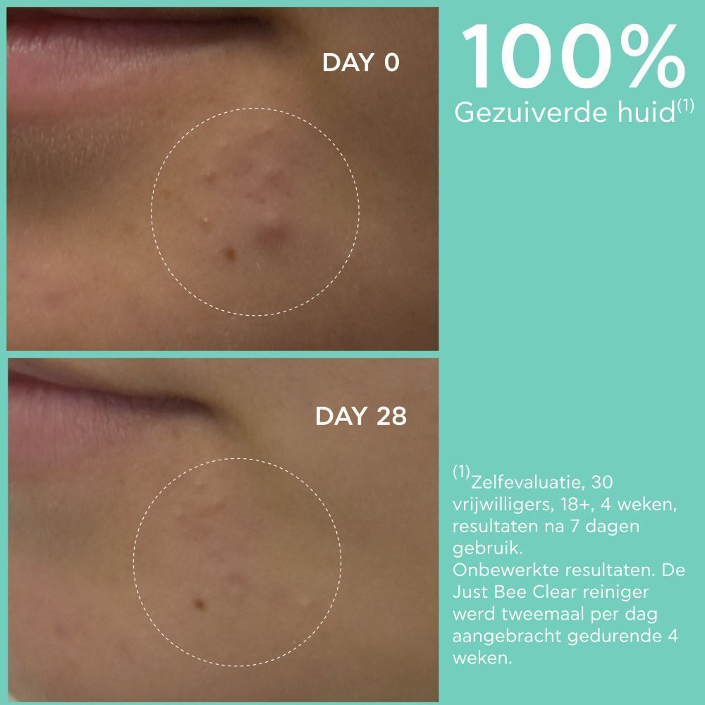 Voor-en-na foto's van huidonzuiverheden. Tekst: 100% zuivere huid na 4 weken.