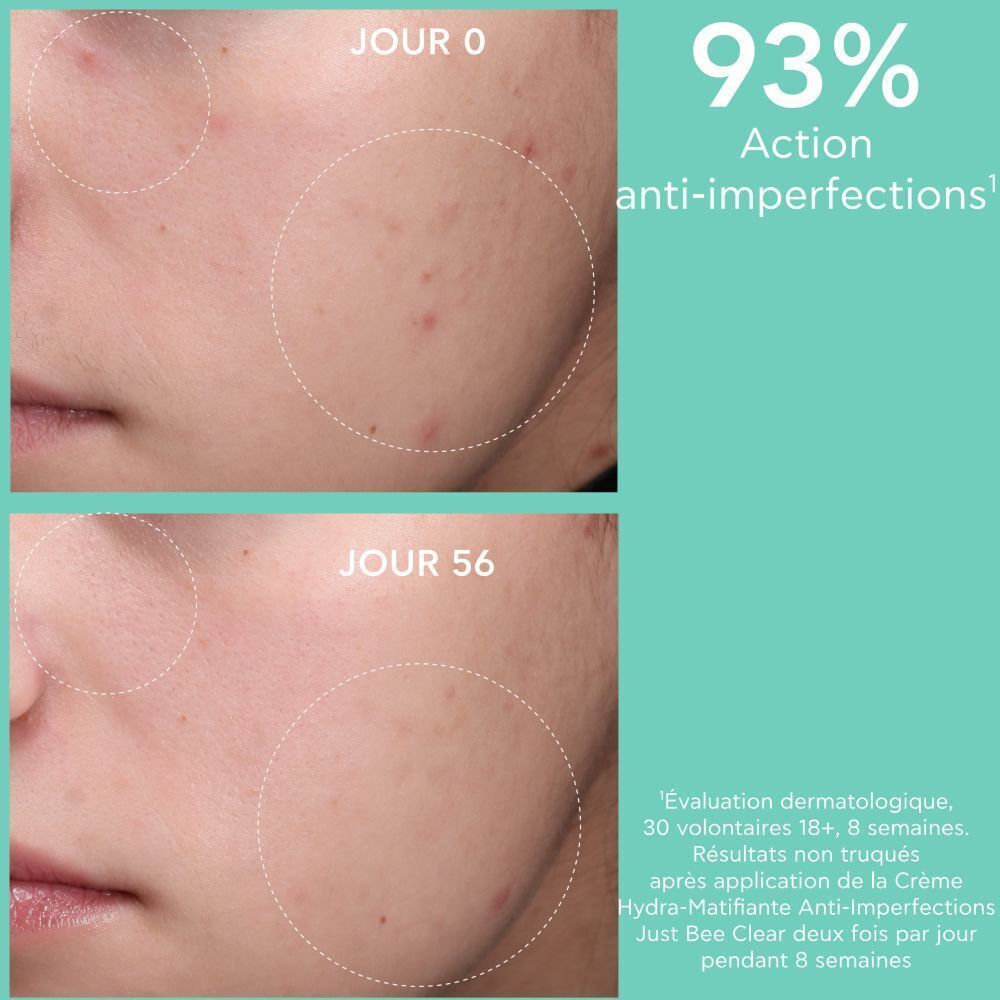 Images avant-après. Texte : Jour 0, Jour 56. 93% d'action anti-imperfections.