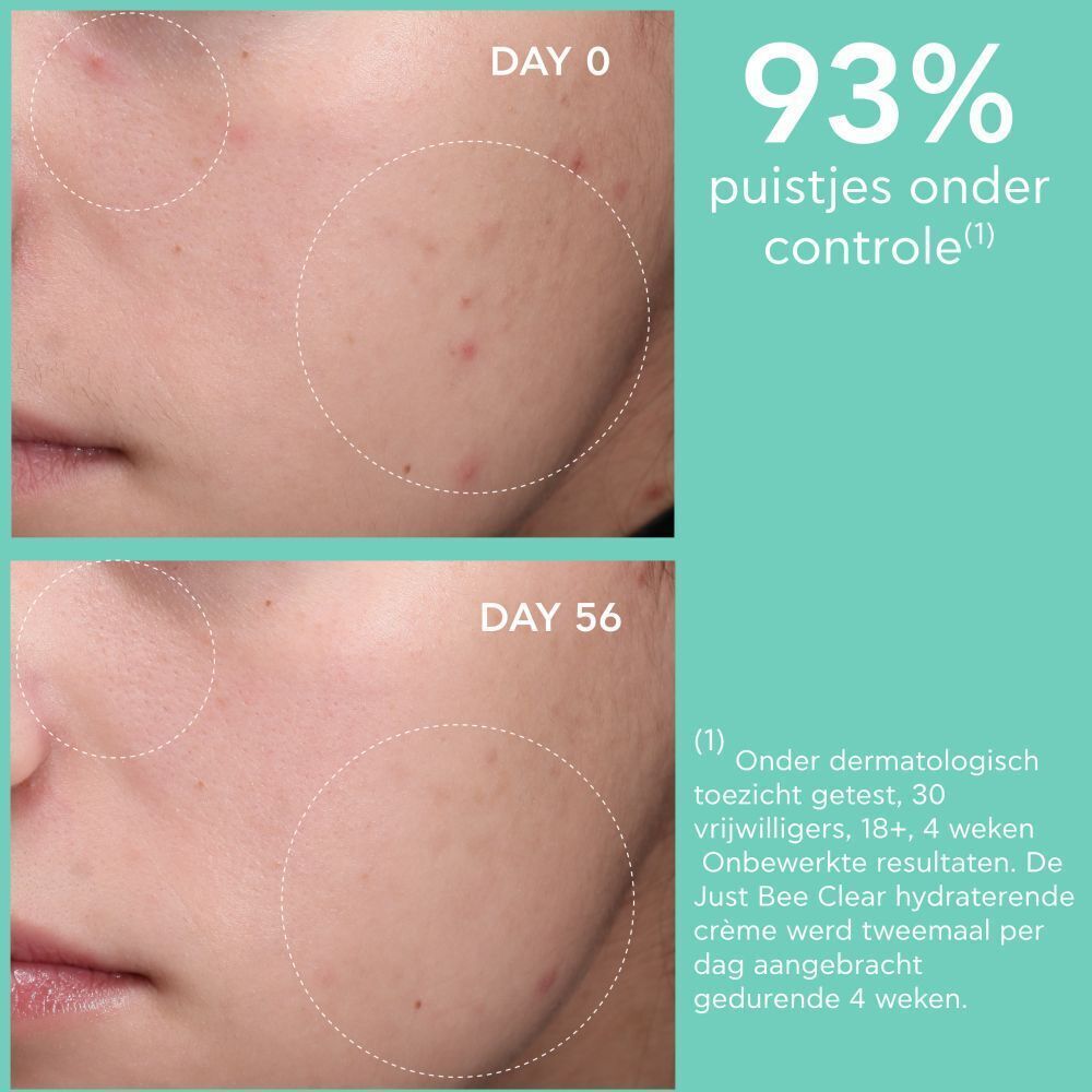 Voor- en na foto's. Tekst: Dag 0, Dag 56. 93% puistjes onder controle.