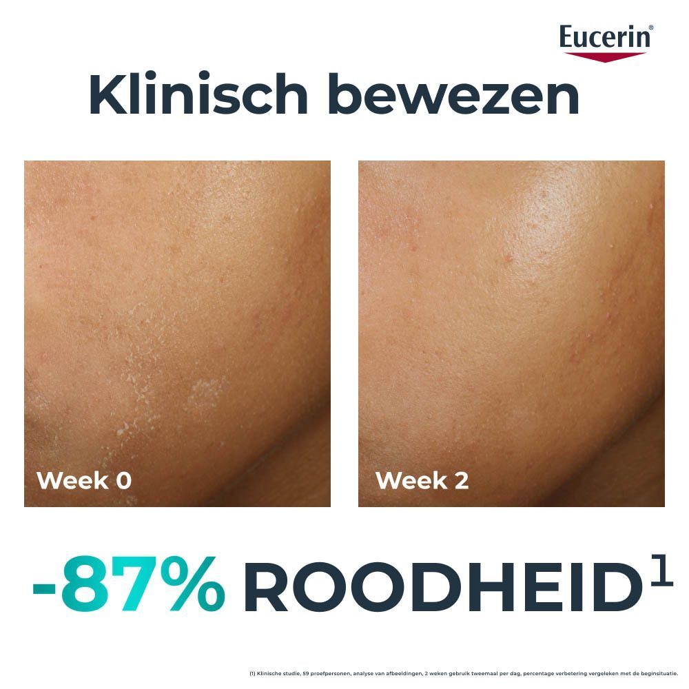 Gezichtshuid voor en na gebruik. Tekst: Klinisch bewezen. -87% Roodheid.