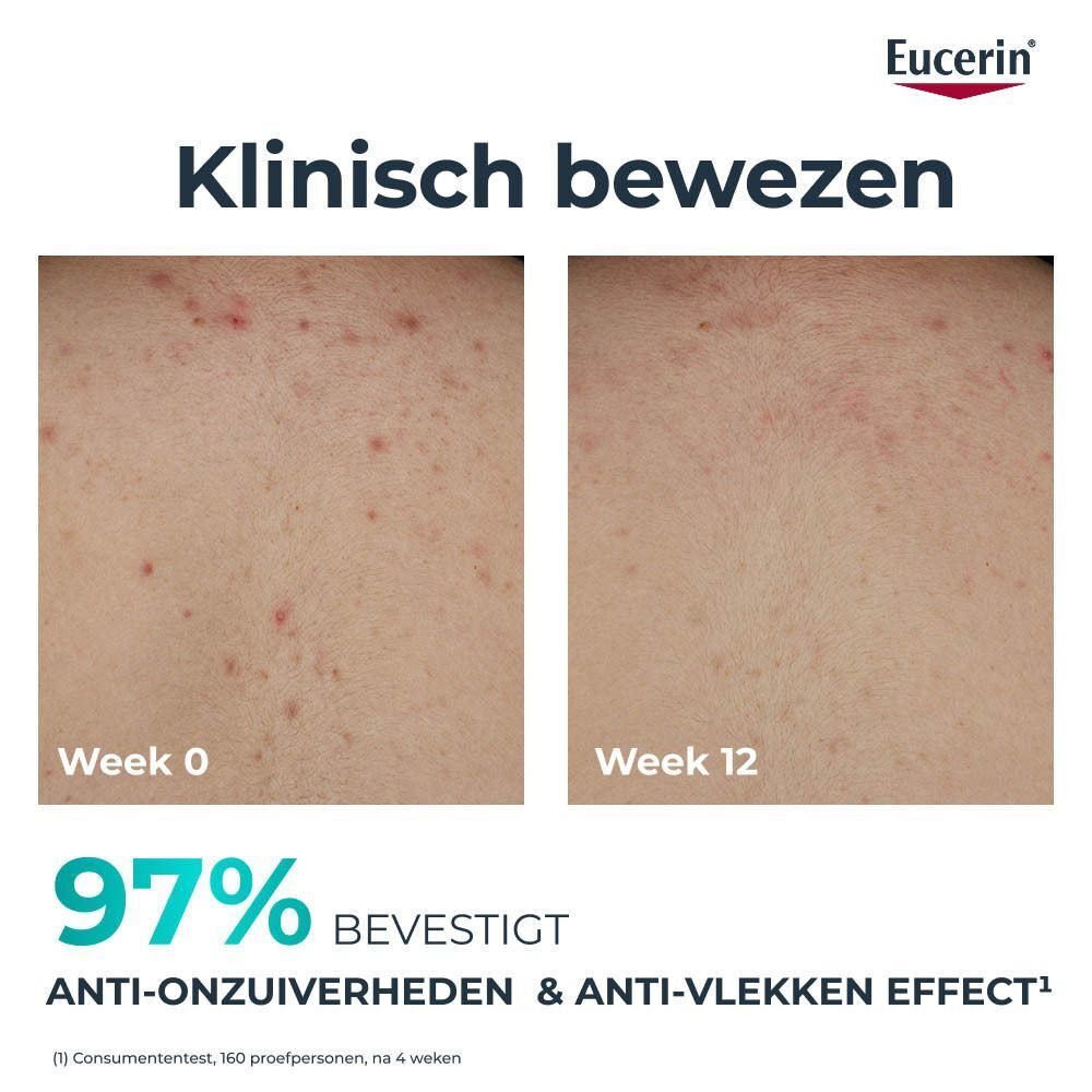 Voor-en-na foto van huid. Tekst: Klinisch bewezen. 97% bevestigt anti-onzuiverheden & anti-vlekken effect.