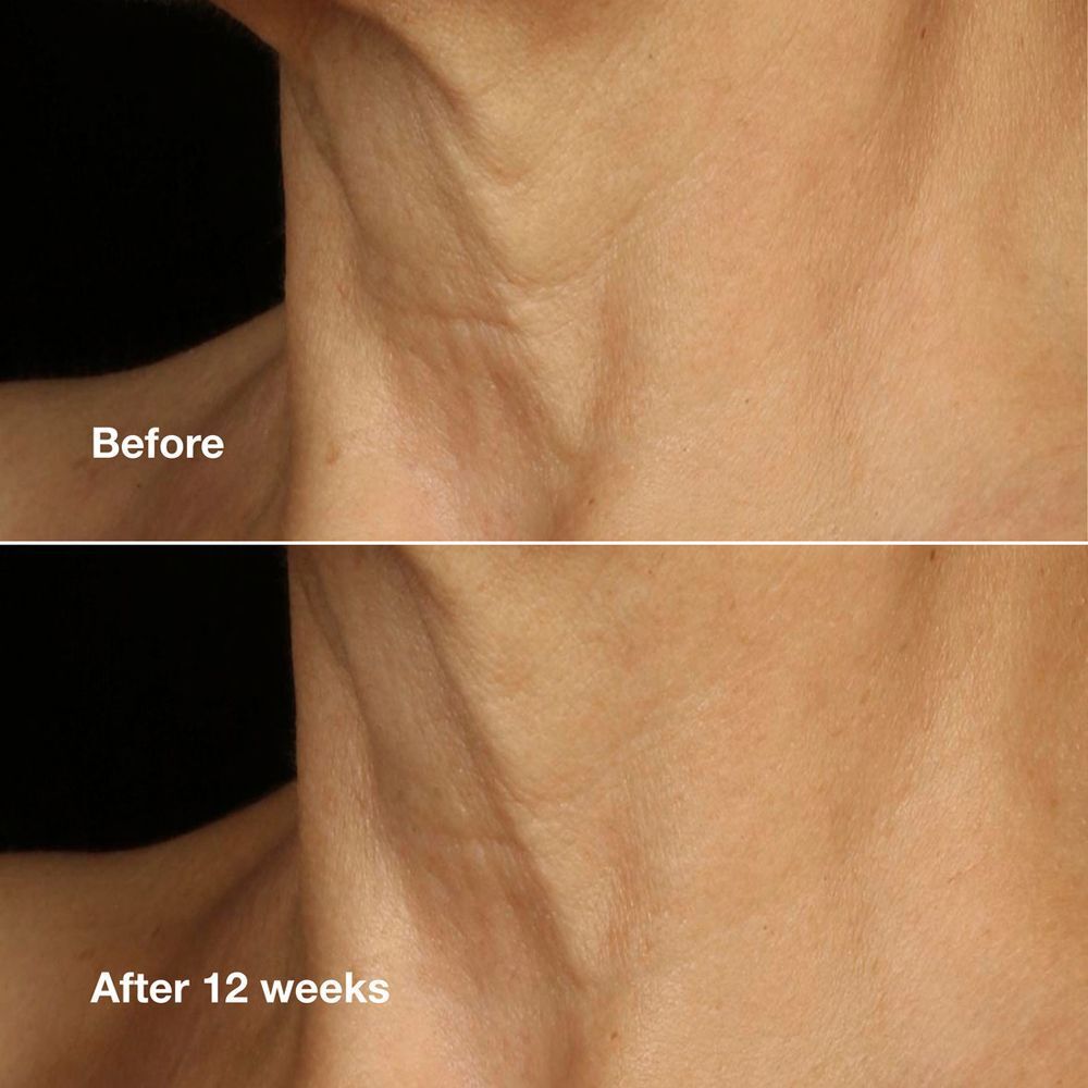 Voor-en-na vergelijking van de huid van de nek, die het effect van Clinique Smart Clinical Repair toont.