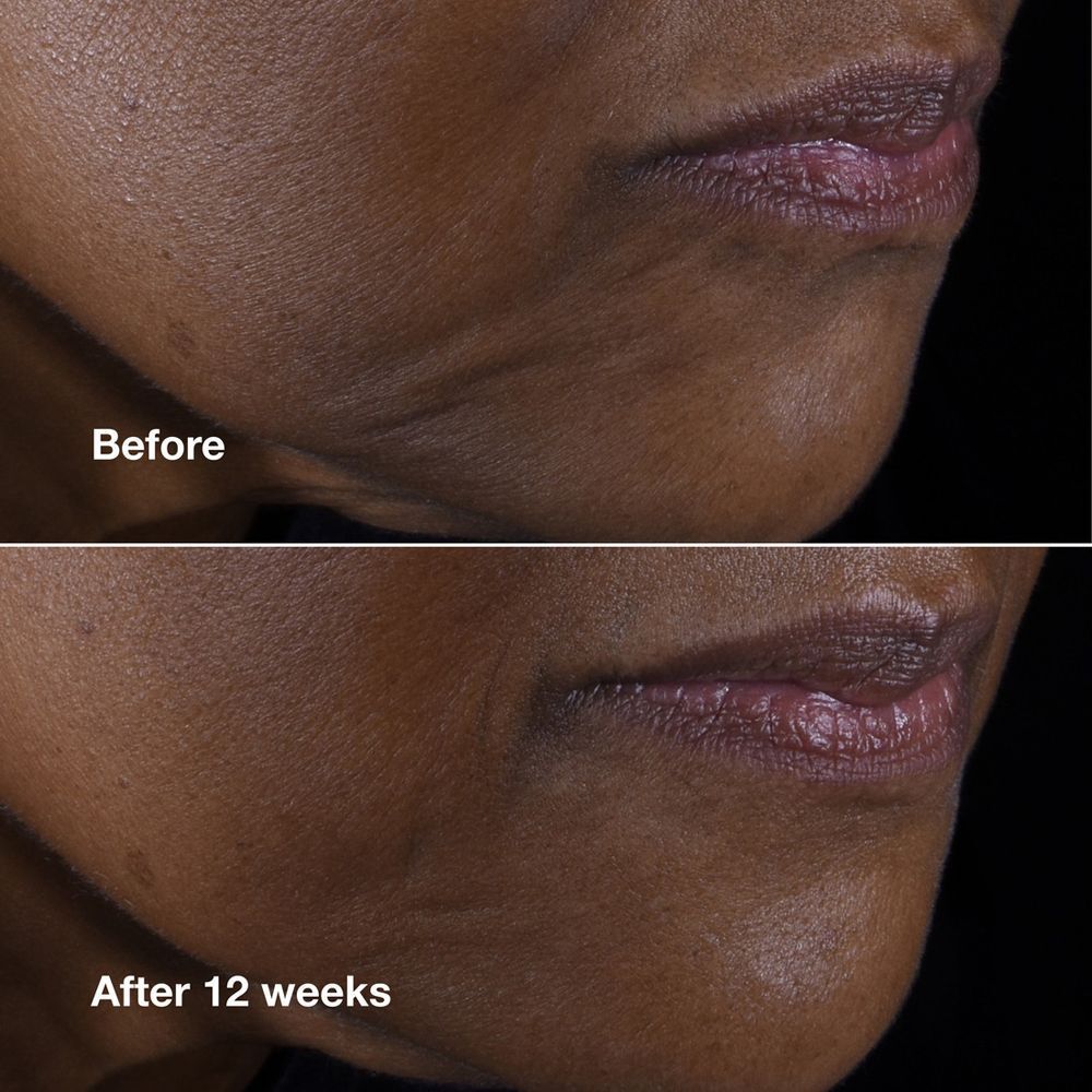 Voor-en-na vergelijking van de huid van de kin, die het effect van Clinique Smart Clinical Repair toont.