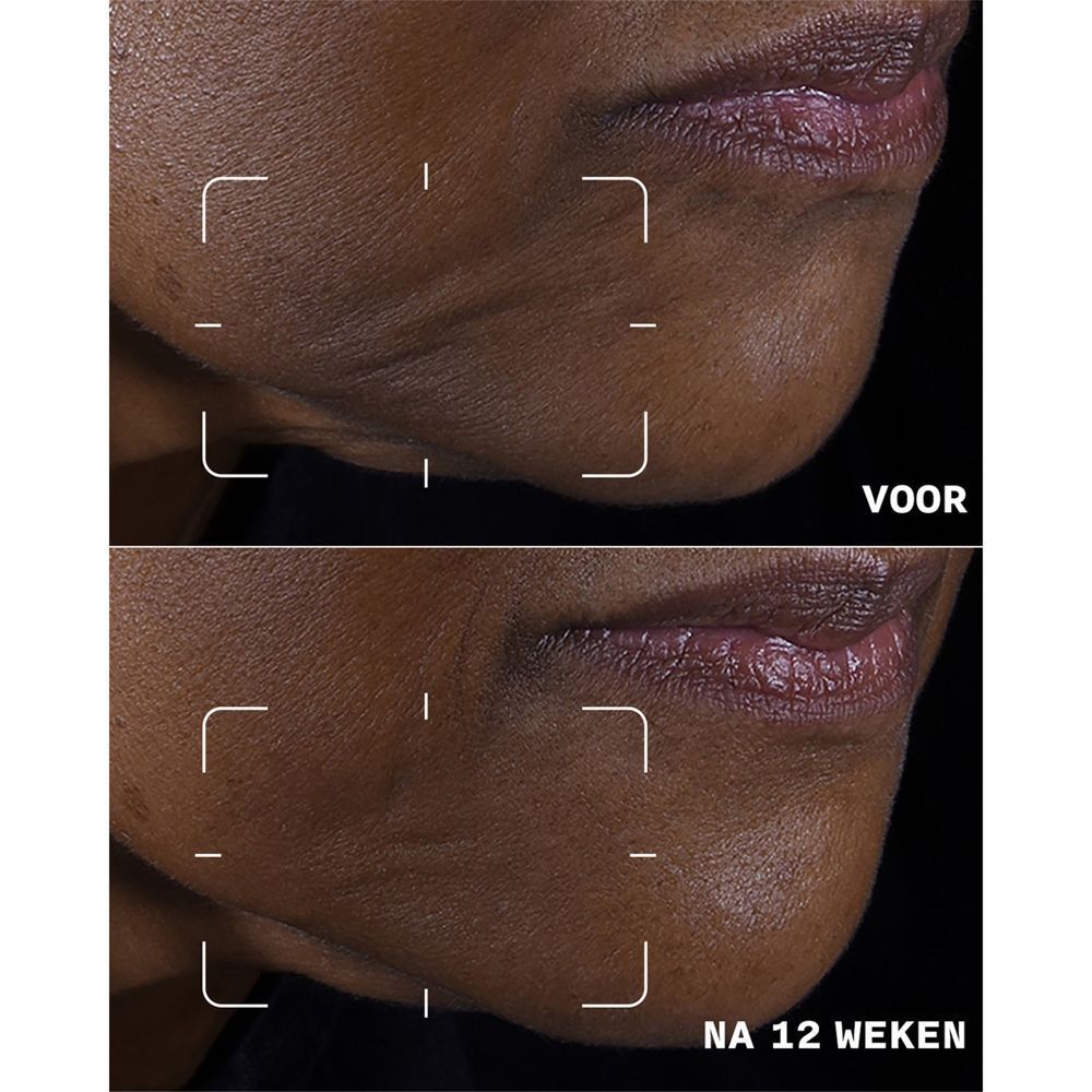 Voor-en-na vergelijking van de huid van de kin, die het effect van Clinique Smart Clinical Repair toont.