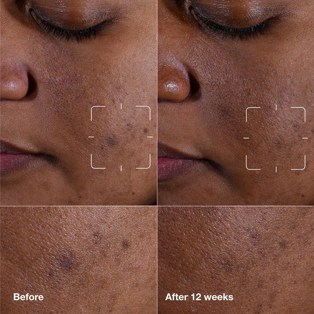 Comparaison avant/après de peau avec taches pigmentaires traitée avec le sérum Clinique Even Better Clinical™.